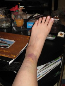 Cruise acquired bruise