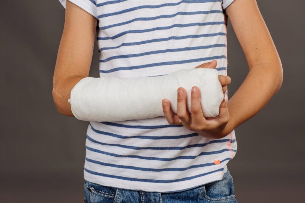 Close-up of a broken arm in a cast on striped shirt background.